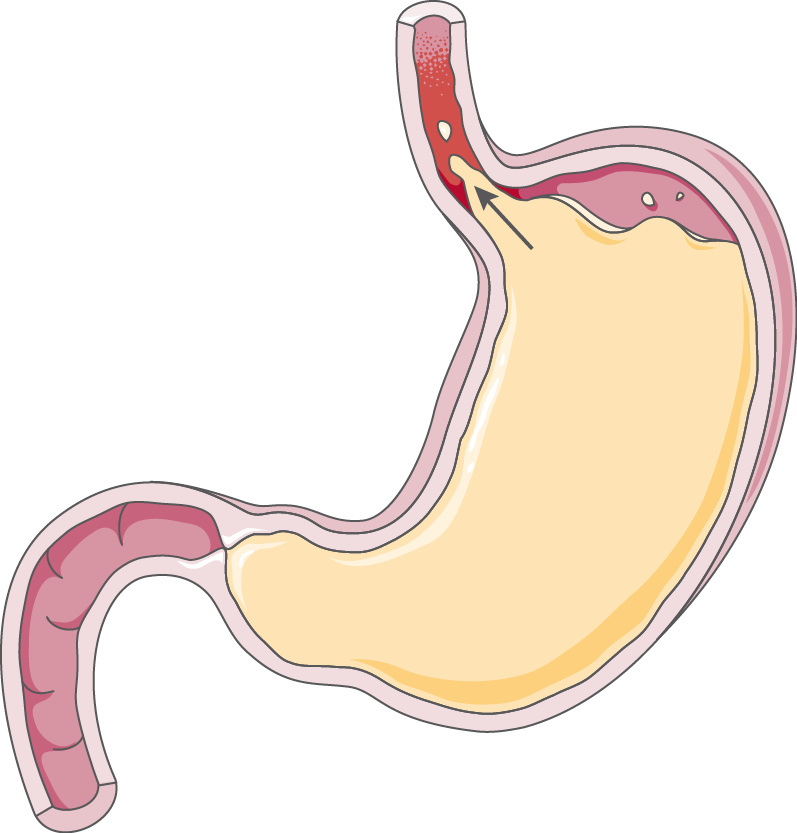 reflux