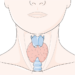 Les Troubles de la Thyroïde